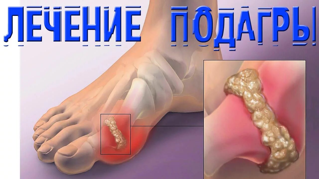 Соль в пятках симптомы. Соль в пятках симптомы