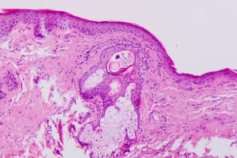 Blepharitis латынь