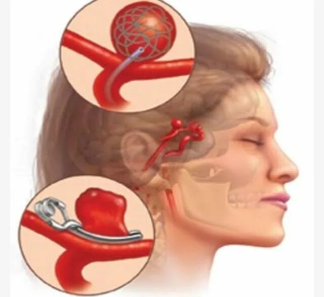 Аневризма церебрального сосуда. Аневризма сосудов головного мозга. Микроаневризма сосудов головного мозга симптомы. Операция аневризма артерии головного мозга. Расширение сосудов головы