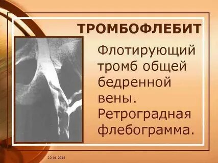 Флотирующий тромб нижней конечности