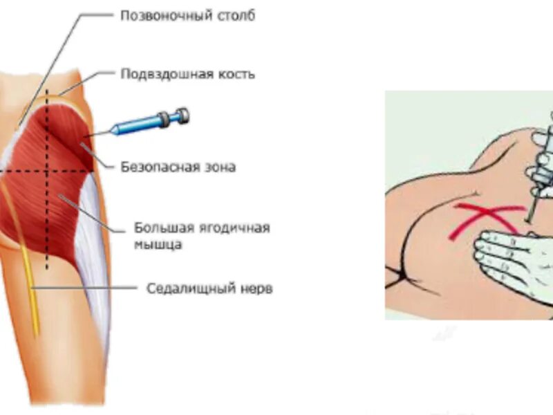 Почему после уколов болит ягодица. Внутримышечные инъекции места введения. Мышцы для внутримышечной инъекции. Инъекция внутримышечно в ягодицу. Правильно поставить укол внутримышечно.