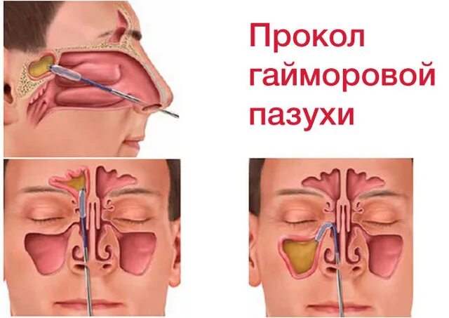 дренаж гайморовых пазух. пункция верхнечелюстной пазухи схема. рентген придаточных пазух носа фронтит. содержимое гайморовой пазухи. содержимое гайморовой пазухи.