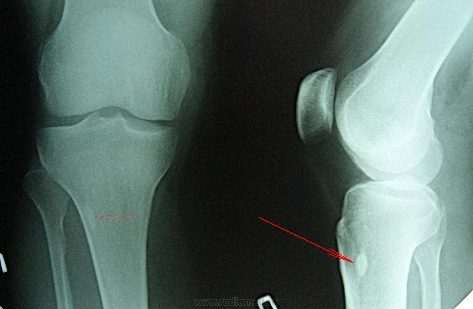 Перелом коленного сустава рентген. Подвывих коленного сустава рентген. Перелом надколенника рентген. Подвывих смещение коленного сустава рентген.