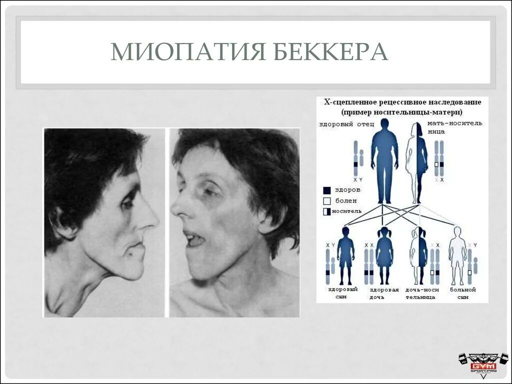 Мышечная дистрофия у детей симптомы. Мышечная дистрофия дюшенна тип наследования. мышечная дистрофия дюшенна-беккера симптомы. дюшенна беккера тип наследования. тип наследования прогрессирующей мышечной дистрофии дюшенна.