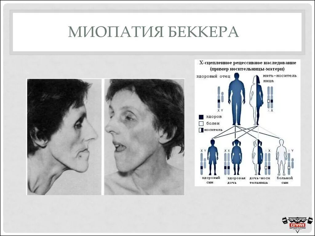 Миопатия глаза что это. Мышечная дистрофия Дюшенна Беккера симптомы. Миодистрофия Дюшенна симптомы. Миопатия Дюшенна Беккера симптомы. Прогрессирующая мышечная дистрофия Беккера симптомы.