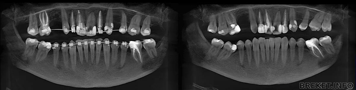 Мрт можно делать с брекетами на зубах. Резорцин формалиновые зубы.