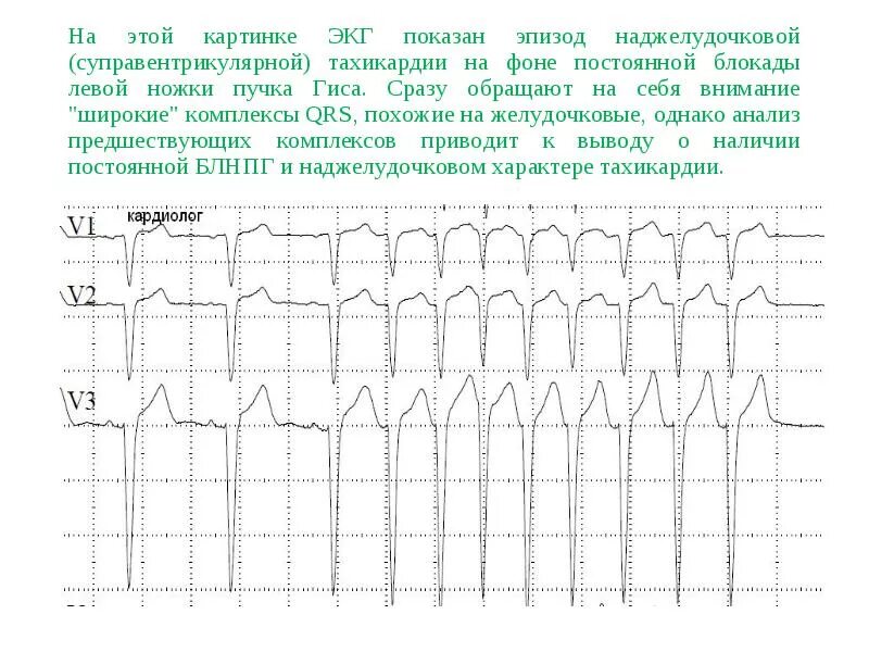 На графике изображена электрокардиограмма