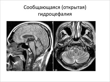 Окклюзионная гидроцефалия