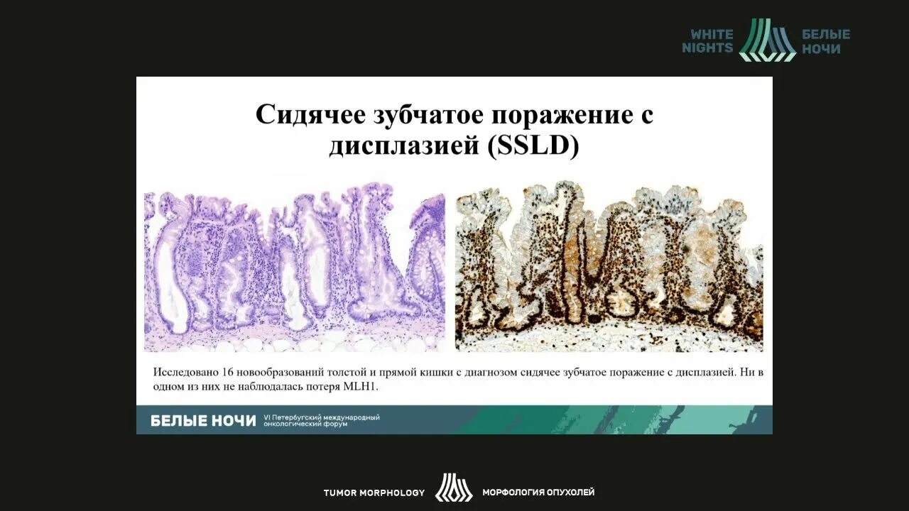 Зубчатая аденома толстой кишки гистология. Зубчатая аденома толстой. Сидячее зубчатое образование. Зубчатые образования толстой кишки. Тубулярная аденома толстой кишки что