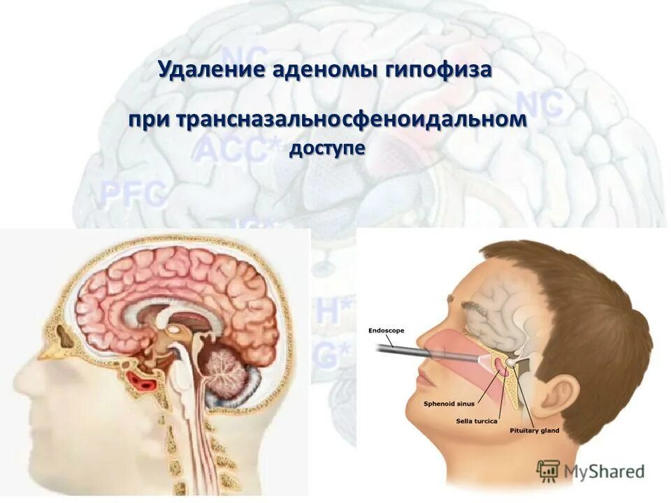Опухоль гипофиза. Удаление аденомы гипофиза. микроаденома гипофиза операция.