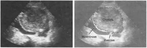 Узи новообразования