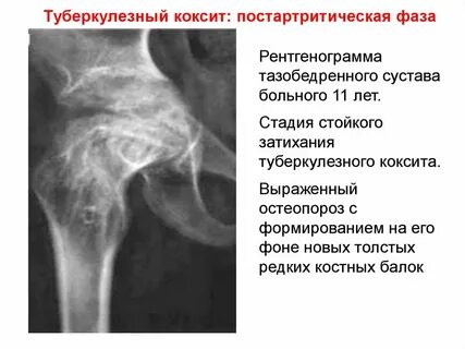 Коксит