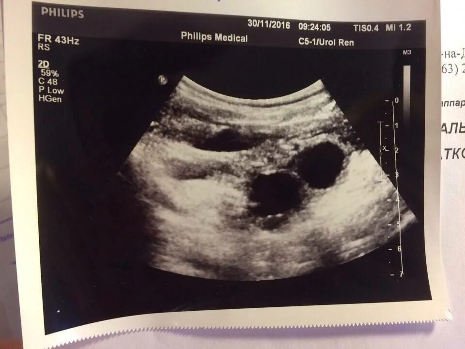 Узи беременности 2. После узи на раннем сроке начались выделения. Коричневые выделения на 10 неделе беременности. Киста и коричневые выделения. Беременность 4 5 недель коричневые.