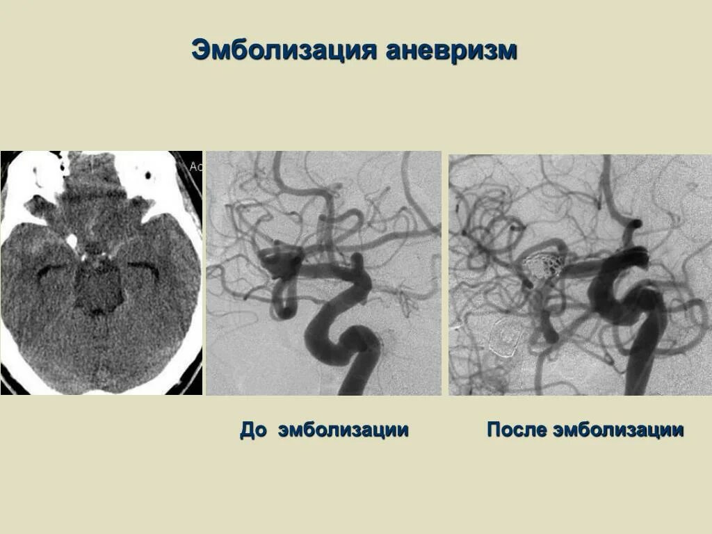 Аневризма головного мозга эндоваскулярным. Чрескожная эмболизация. Эмболизация аневризмы спиралью.