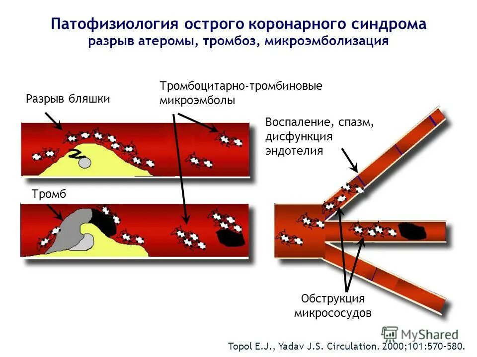 Разрыв бляшки