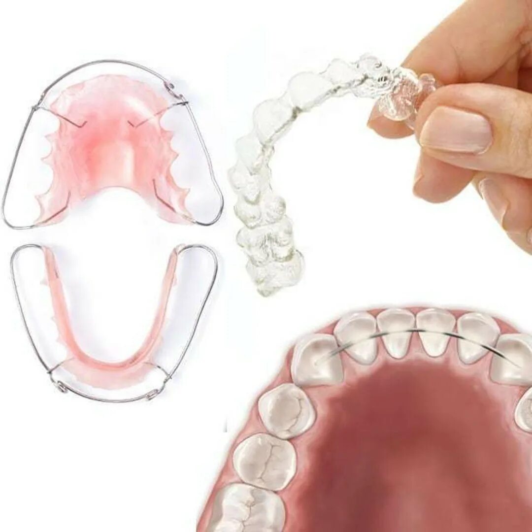 несъемный флекс-ретейнер. шинирование зубов ретейнер. Hawley ретейнер. несъемный флекс-ретейнер. несъемный флекс-ретейнер.