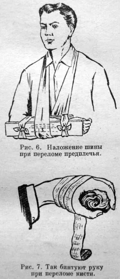 транспортная иммобилизация при переломе плечевой кости. иммобилизация при открытом переломе. иммобилизация шиной крамера при переломе костей предплечья. шина на руку при переломе. шина крамера перелом предплечья.