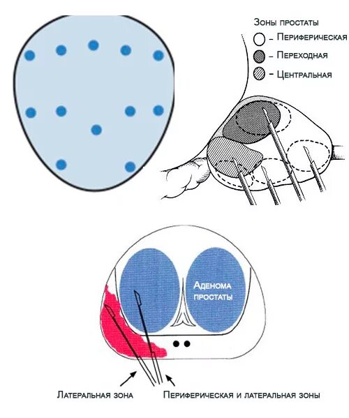 Точка простаты. Схема биопсии простаты. Схема биопсии предстательной железы. Схема взятия биопсии простаты.