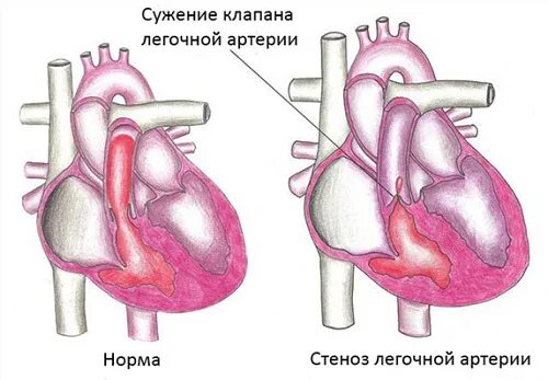 Врожденный стеноз клапана легочной артерии. Изолированный стеноз легочной артерии гемодинамика. Впс подклапанный стеноз аорты. Стеноз устья легочного ствола. Сужение легочного клапана сердца.