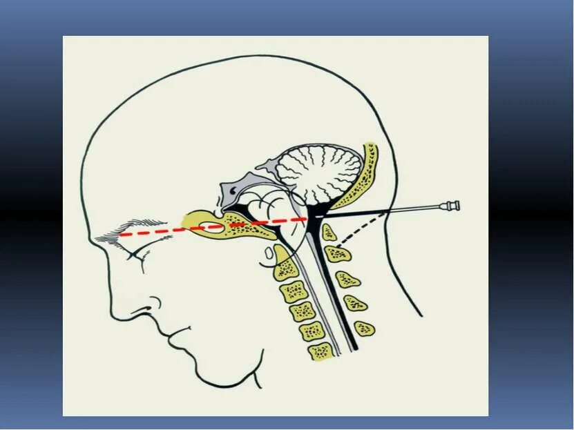 Как делают пункцию мозга. Субокципитальная пункция. Пункция вентрикулярная люмбальная субокципитальная. Субокципитальная пункция ликвора. Субокципитальный прокол.