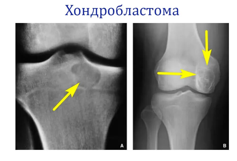 Два мыщелка. Остеосаркома коленного сустава рентген. Остеома бедренной кости рентген. Хондробластома рентген. Хондробластома бедренной кости рентген.