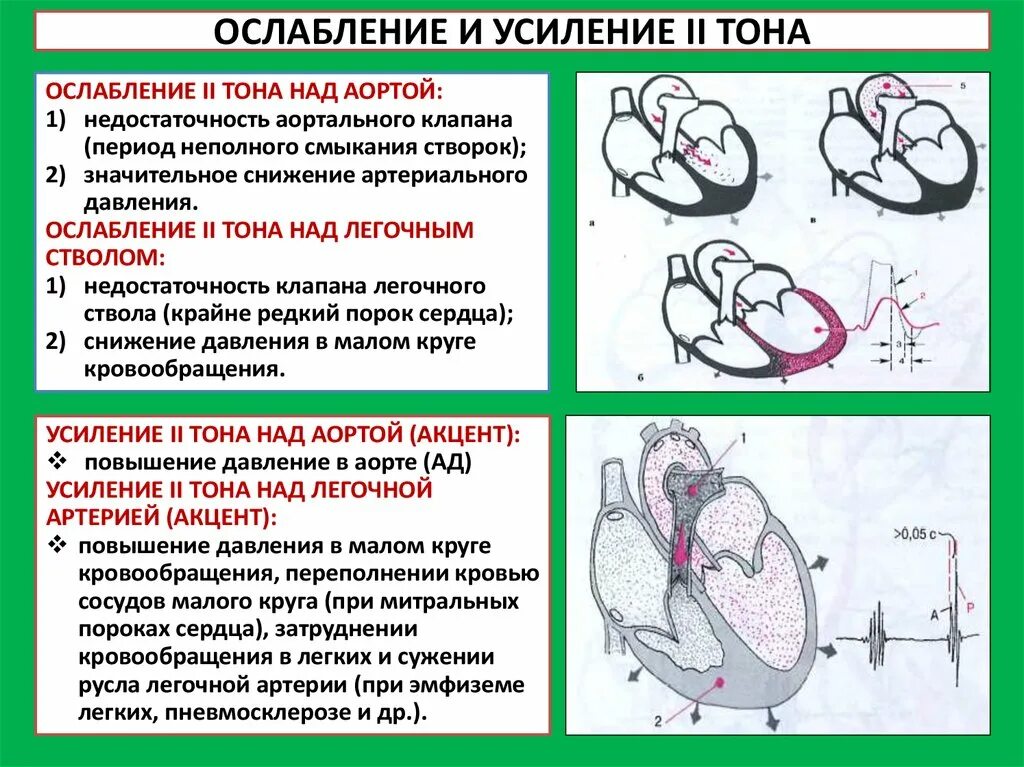 Аортальная недостаточность ослабление 1 тона. Недостаточность аортального клапана тоны сердца. Ослабление первого тона при аортальной недостаточности. 1 Тон сердца при аортальной недостаточности.