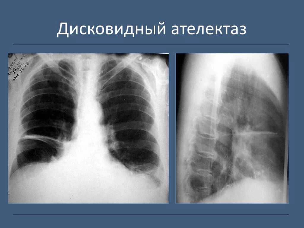 Дисковидный ателектаз легкого рентген. Дисковидный ателектаз рентген. Сегментарный ателектаз рентген. Сегментарный ателектаз легкого рентген. Почему уменьшается легкое