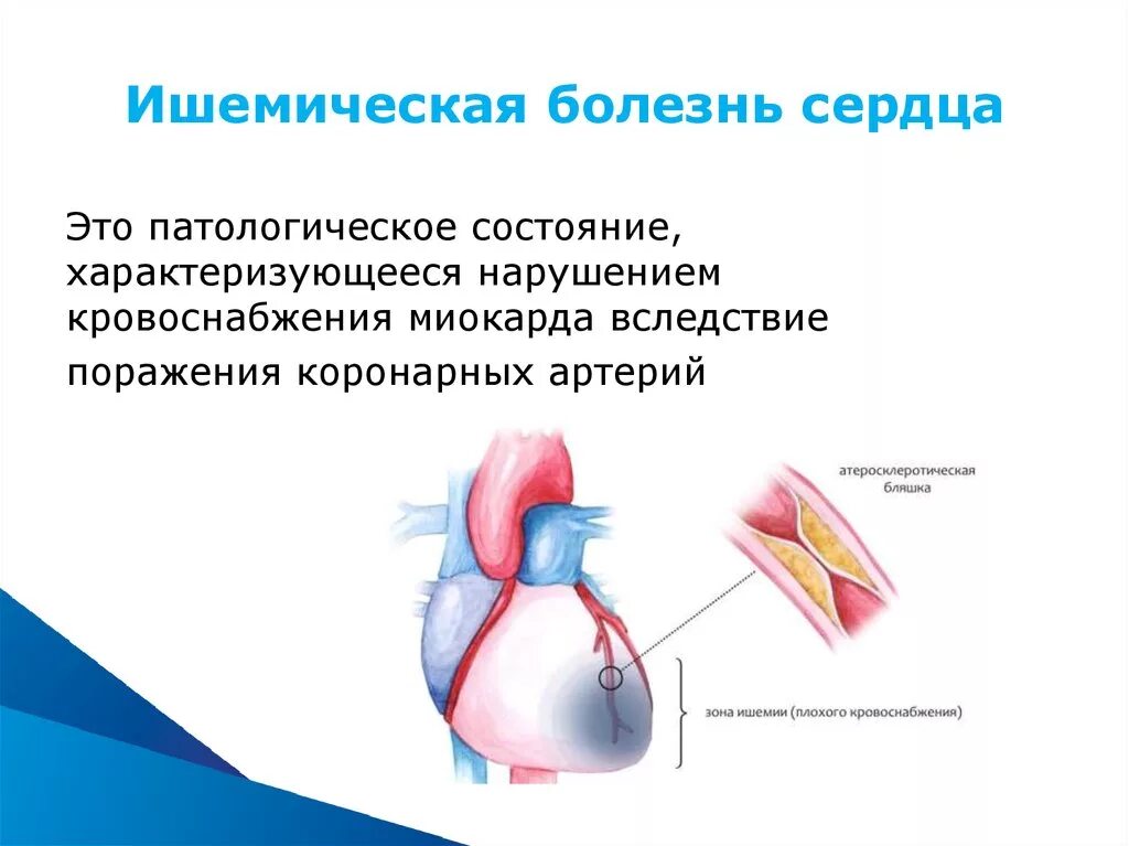 Ишемия крови. Синдром ишемической болезни сердца симптомы. Изменения в коронарных артериях при ишемической болезни сердца.. Ишемышечная болезнь сердца. 1.1. Ишемическая болезнь сердца.