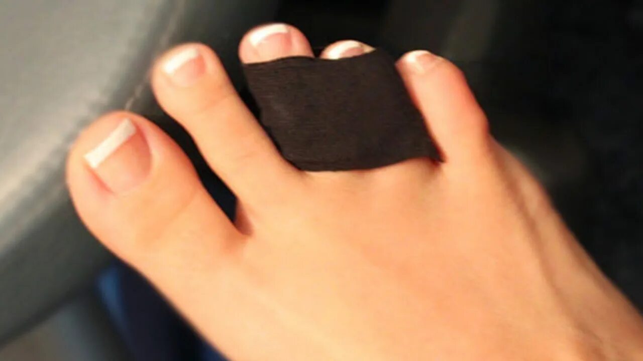 Протез большого пальца стопы. Пластырная повязка на мизинец ноги. Воспаление мизинца на ноге. Палец ноги на другом пальце. Воспаление пальцев ног.