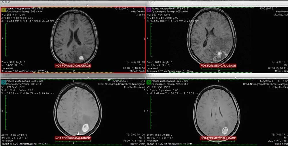 Метастазы меланомы в головной мозг кт. Метастазы меланомы в головной мозг мрт. Метастазы в головной мозг при меланоме мрт. Метастазы головного мозга кт.