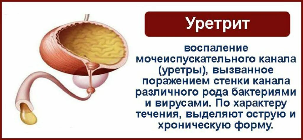 Бактериальный уретрит у мужчин. Воспаление мочевого канала. уретрит воспаление уретры.