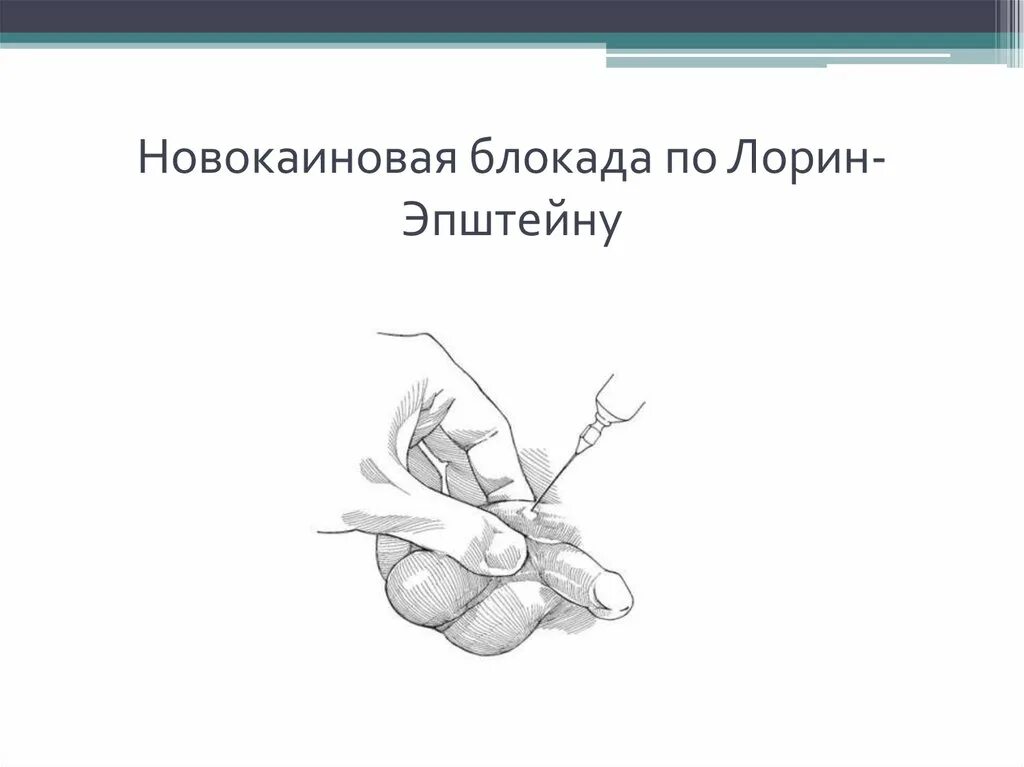 Блокады половые. Блокада семенного канатика по Лорин-Эпштейну техника. Блокада по Лорину Эпштейну техника. Техника новокаиновой блокады семенного канатика по Лорин-Эпштейну. Новокаиновая блокада семенного канатика.