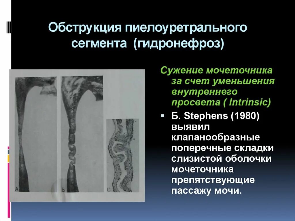 Обструкция мочеточника. Пиулоуретралоный сегмент. Стеноз пиелоуретерального сегмента. Расширение пиелоуретрального сегмента мочеточника. Обструкция пиелоуретерального сегмента.