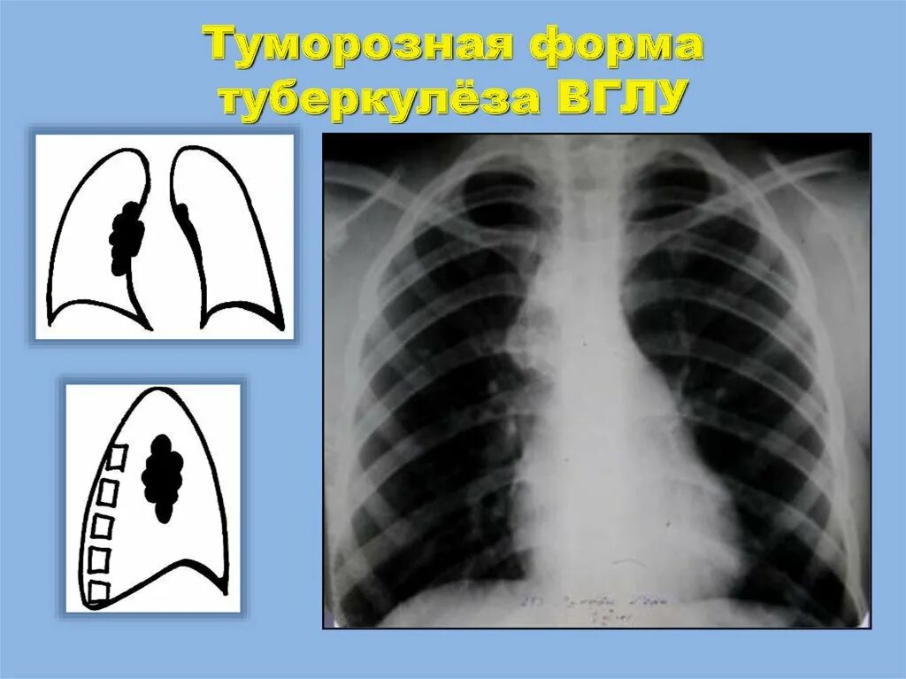 Бронхоаденит это