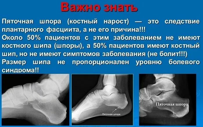 Голеностопный сустав инвалидность. Плантарный фасциит стопы и УВТ.