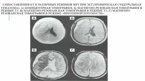 Чем отличается кт и мрт головного мозга