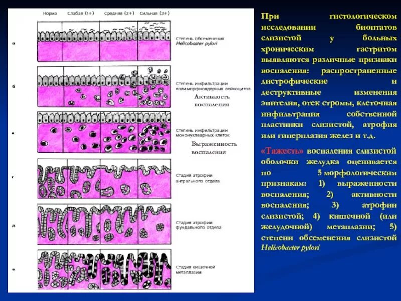 Степени активности хронического гастрита. Острый гастрит гистология. Классификация хронических гастритов по гистологии. Морфология хронического гастрита. Цитограмма биоптата слизистой желудка.