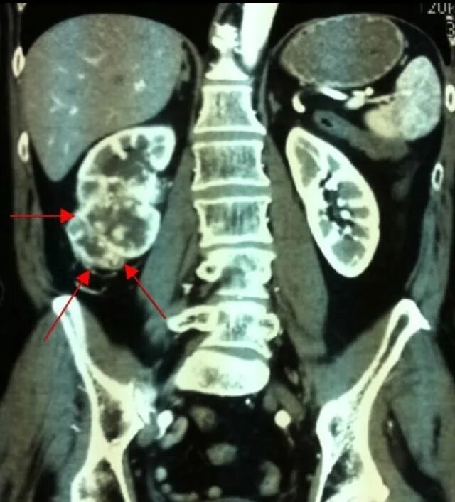 Магнитно-резонансная томография почки опухоль. Снимок почки кт с контрастом. Мрт почек. Снимки мрт почек. На кт видно опухоль