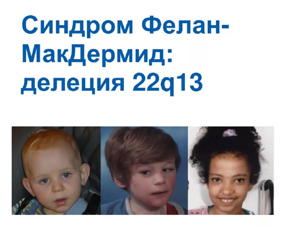 Синдром средних лет. Фелан макдермид синдром. синдром фелан-макдермид у ребёнка. синдром фелана-макдермид фото. синдром финал макдермид.