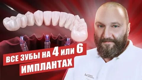 Все на 4 имплантах отзывы форум