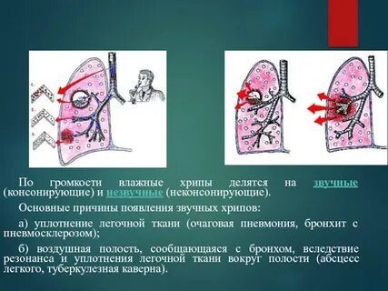 Трудно дышать хрип