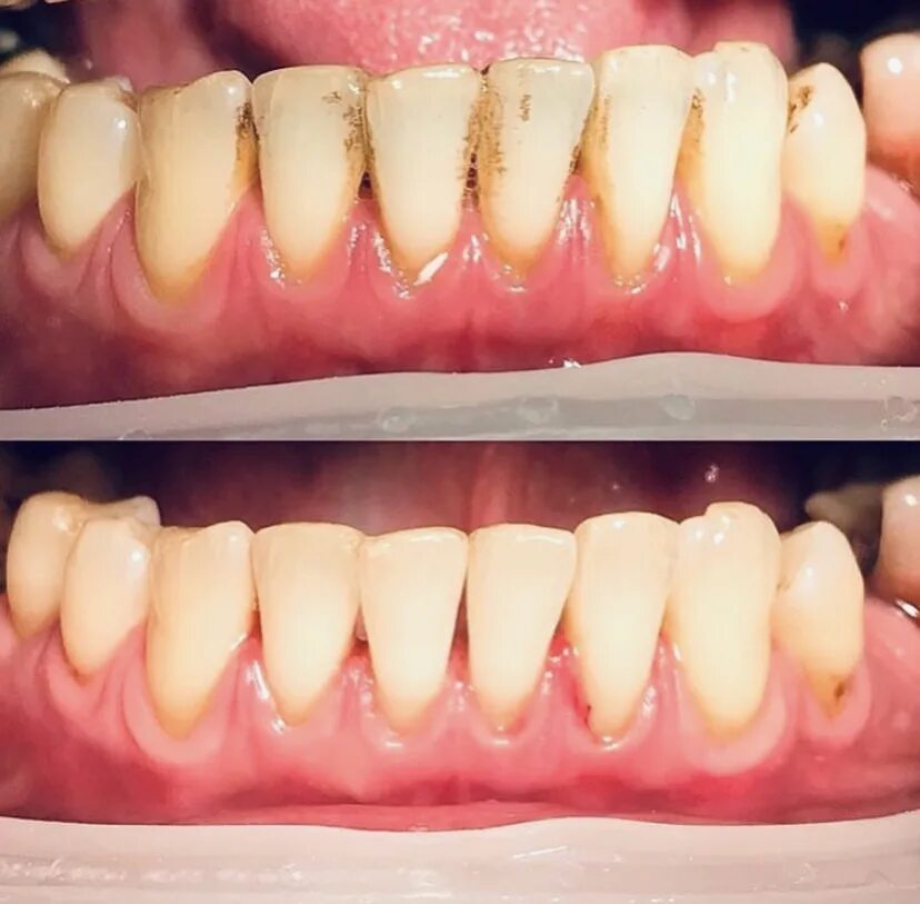 Teeth whitening mousse от lanbena. гигиены полости рта. после проф гигиены. читск азуюов до и после. язвенно некротический гингивит профгигиена.