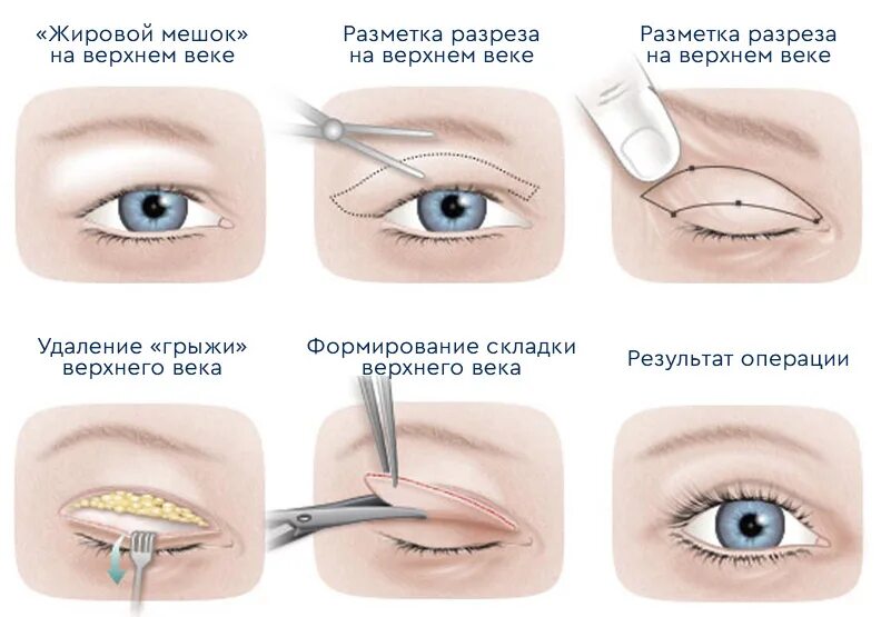 Блефаропластика разметка верхних век. Схема блефаропластики верхних век. Блефаропластика верхних век швы реабилитация. Блефаропластика нижних век схема операции.