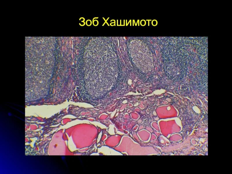 Аутоиммунный тиреоидит Хашимото микропрепарат. Тиреоидит Хашимото гистология. Зоб щитовидной железы макропрепарат. Зоб Хашимото гистология.