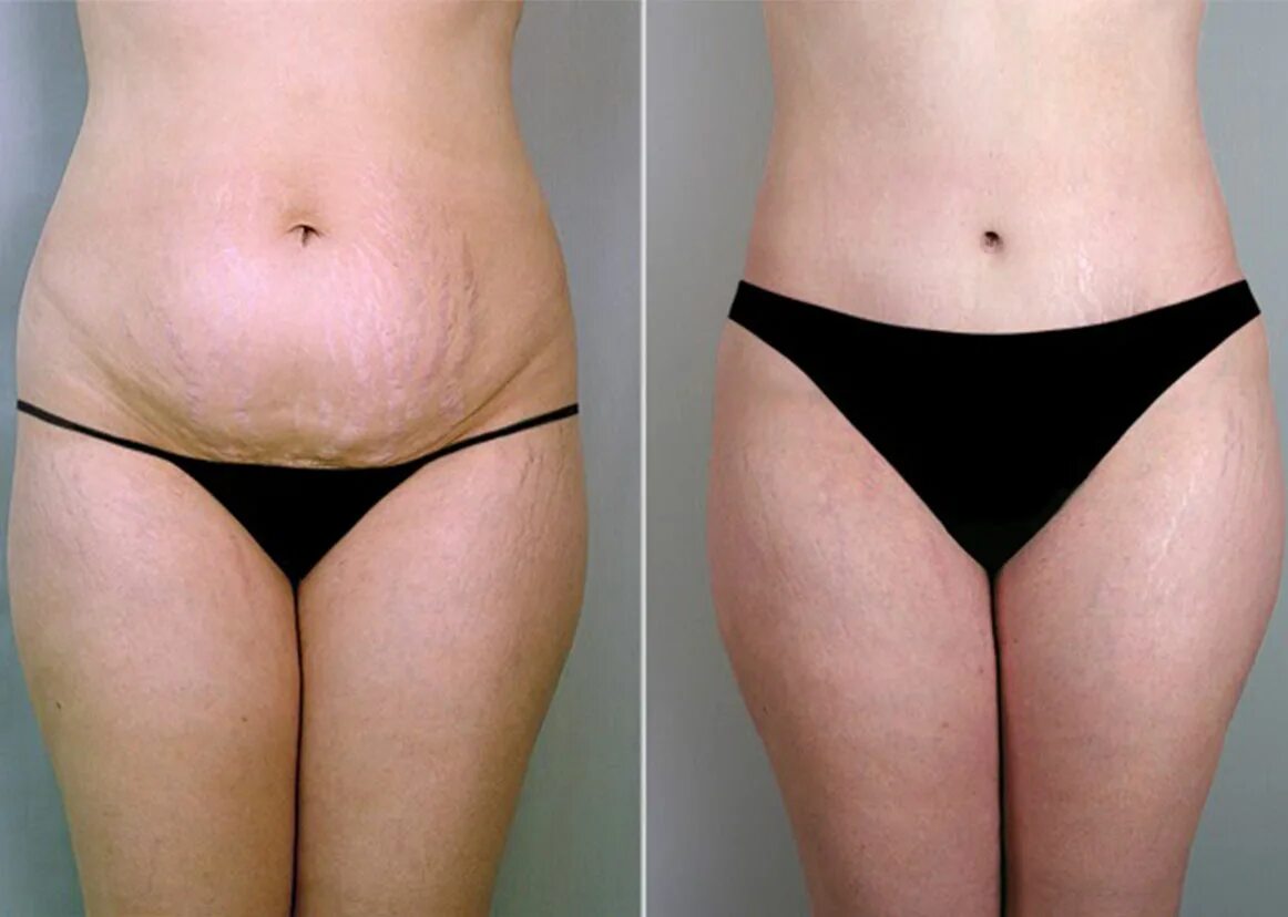 Как называется операция по удалению живота. Липосакция липоскульптура. Абдоминопластика живота до и после. Абдоминопластика серома. Абдоминопластика лилия нилова.