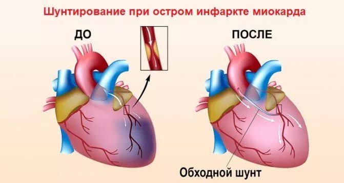 Шунт при инфаркте миокарда. Коронарное шунтирование сосудов сердца. Операция коронарное шунтирование сосудов сердца. Шунтирование коронарных артерий схема. Как выглядит шунт