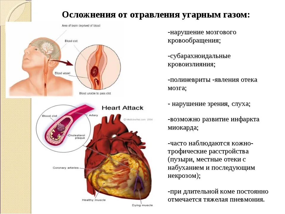 1 из основных признаков отравления угарным газом. Осложнения при отравлении окисью углерода. отравление оксидом углерода симптомы. отравление угарным газом осложнения. последствия отравлением угарного газа.