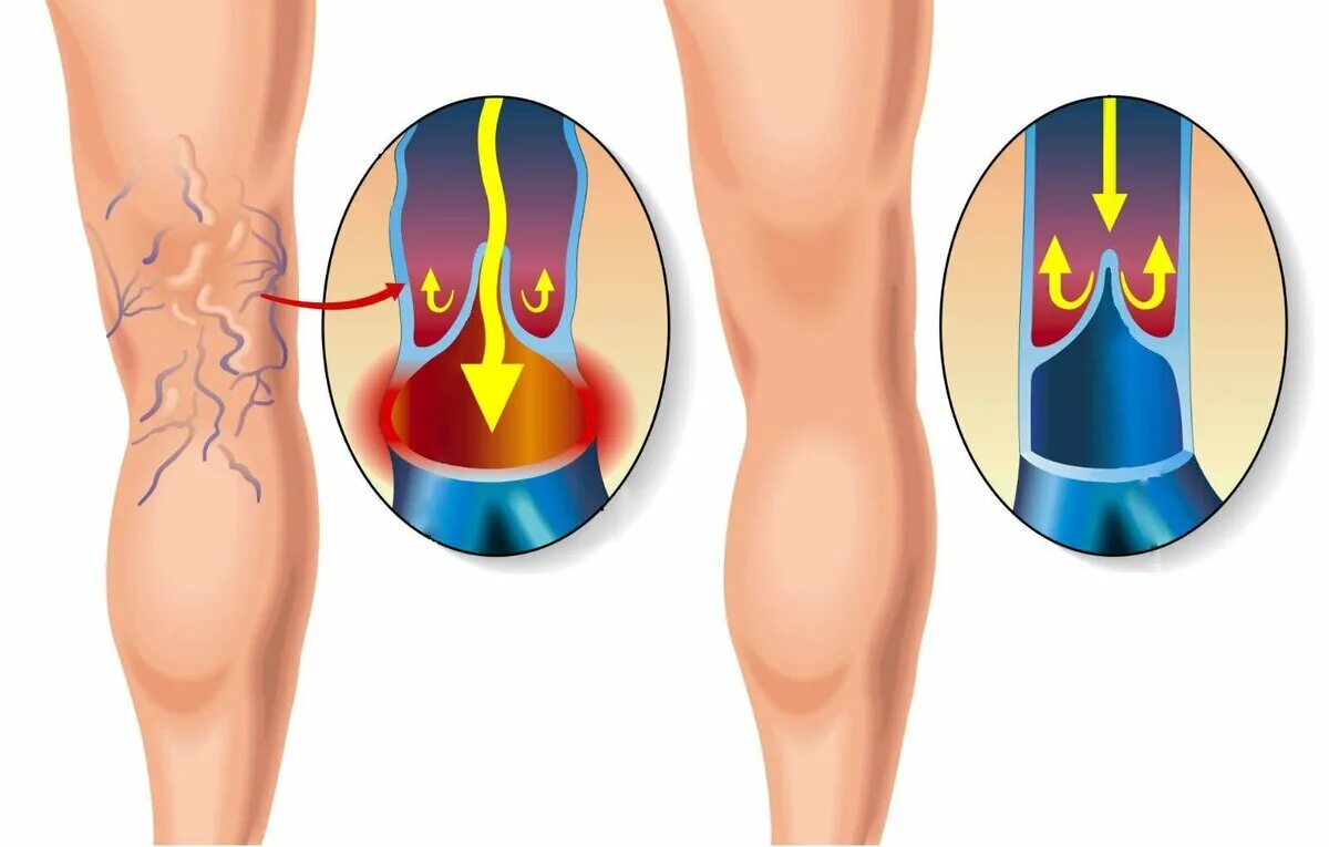 Варикозное расширение вен на ногах. Варикозные вены рефлюкс. Варикозная болезнь вен нижних конечностей. Циркуляция крови в ногах варикоз. Тромбоз вен таза