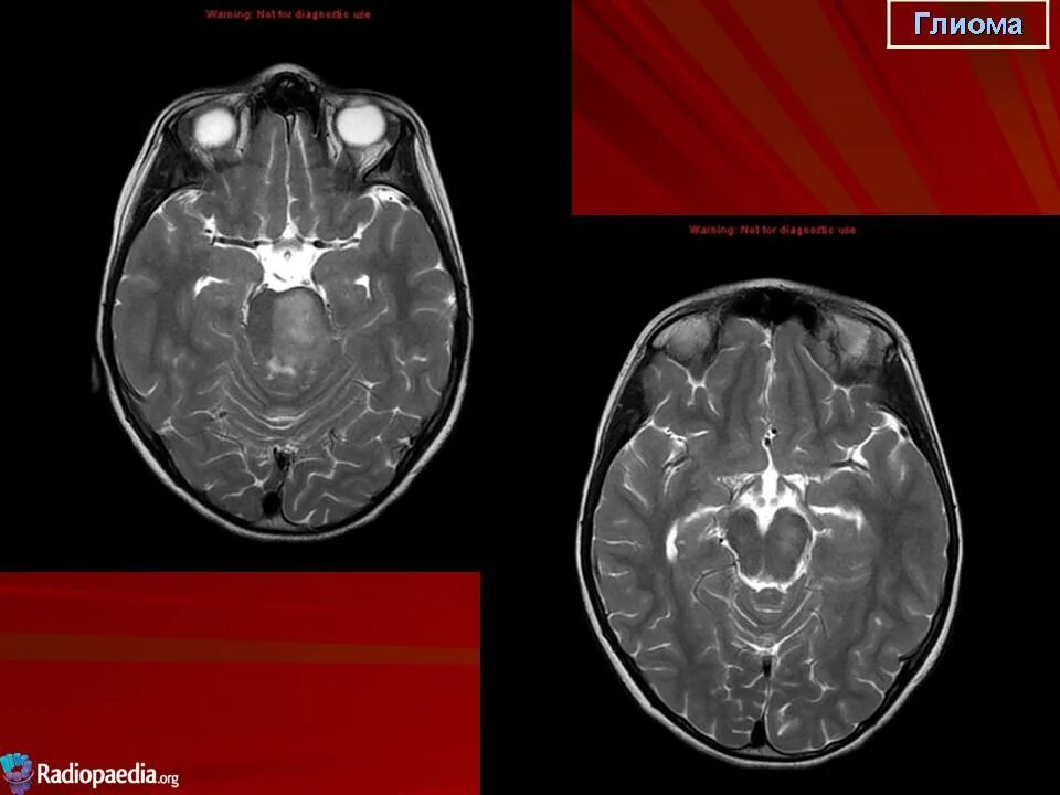 Что такое глиома. Глиома зрительного нерва мрт. Диффузная глиома ствола головного мозга. Глиома ствола мозга мрт.