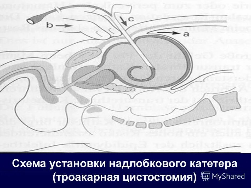 Открытая цистостомия техника операции. Троакарная цистостомия. Уход за больными с цистостомой алгоритм. Цистостома карта. Особенности ухода за пациентом с цистостомой.